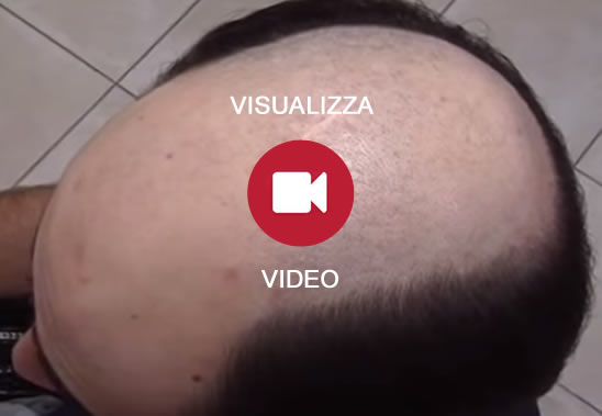 protesi capelli caserta