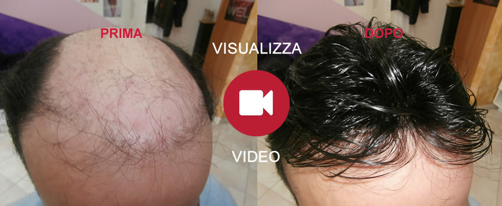 Protesi capelli Caserta - parrucche capelli naturali per chemioterapia